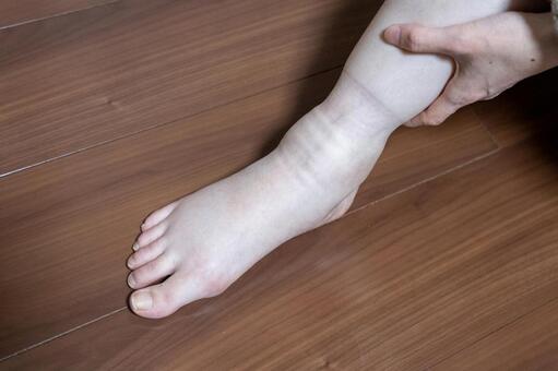 「むくみで足にくっきり跡が残っている足首」