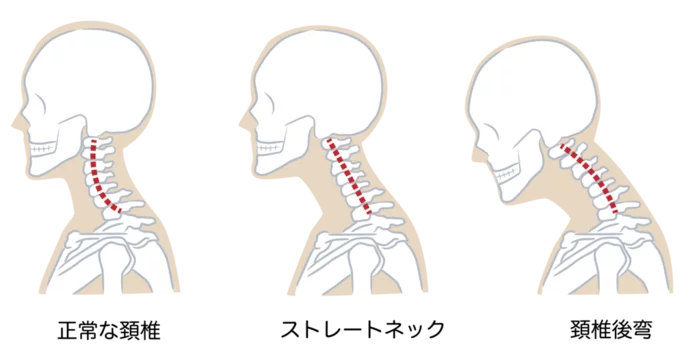 正常な頸椎とストレートネック、頸椎後弯を比較したイラスト