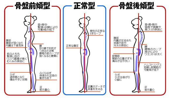 正常姿勢と骨盤前傾・後傾を比較した姿勢図解イラスト